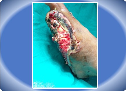 LOWER LIMB INJURY